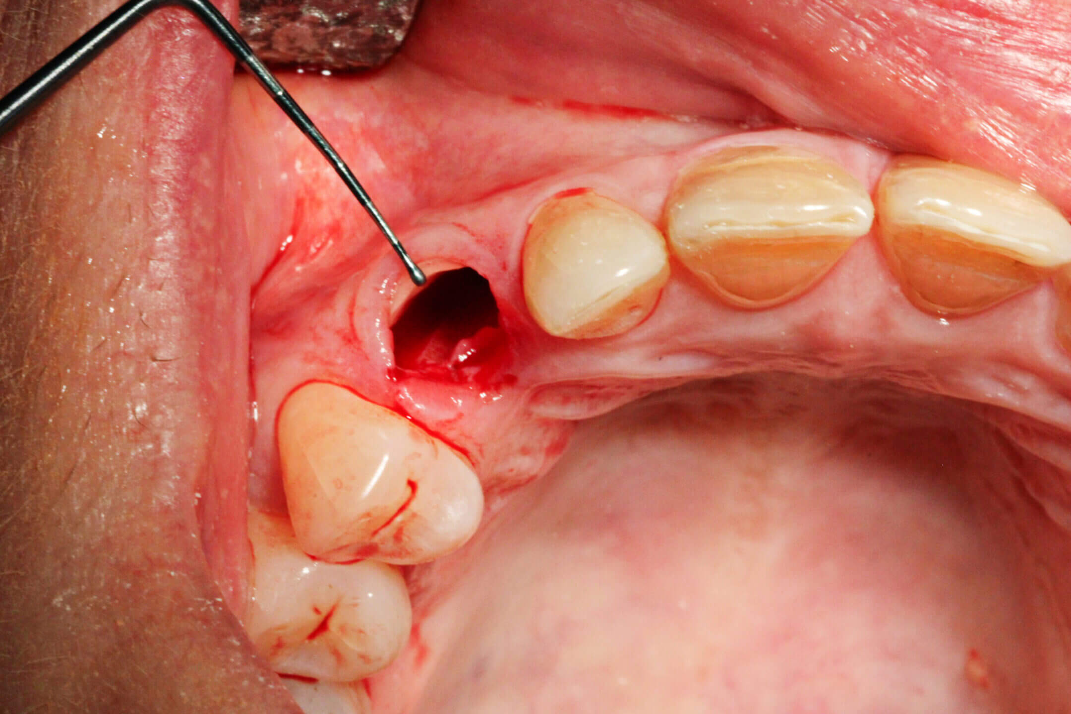 Abb. 7: Implantatplanung mit Sicat Implant