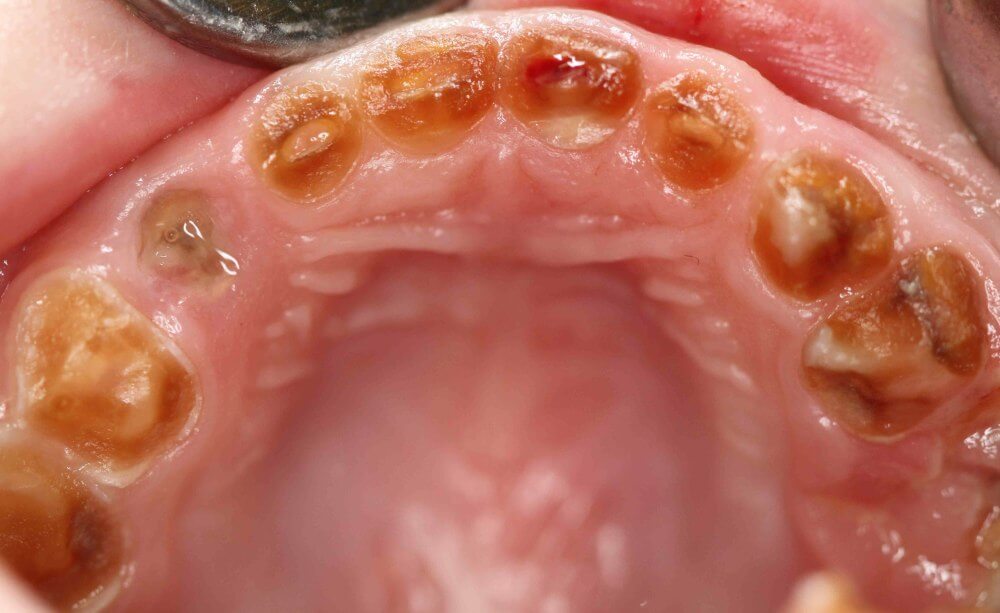 Wo fängt bei kariösen Zähnen Kindeswohlgefährdung an? Es gibt keinen Grenzwert für die Anzahl kariöser Zähne, die zwangsläufig zur Diagnose dentaler Vernachlässigung führt. Allerdings deutet ein stark kariöses Milchgebiss auf eine chronische Unterlassung der Fürsorgepflicht hin.