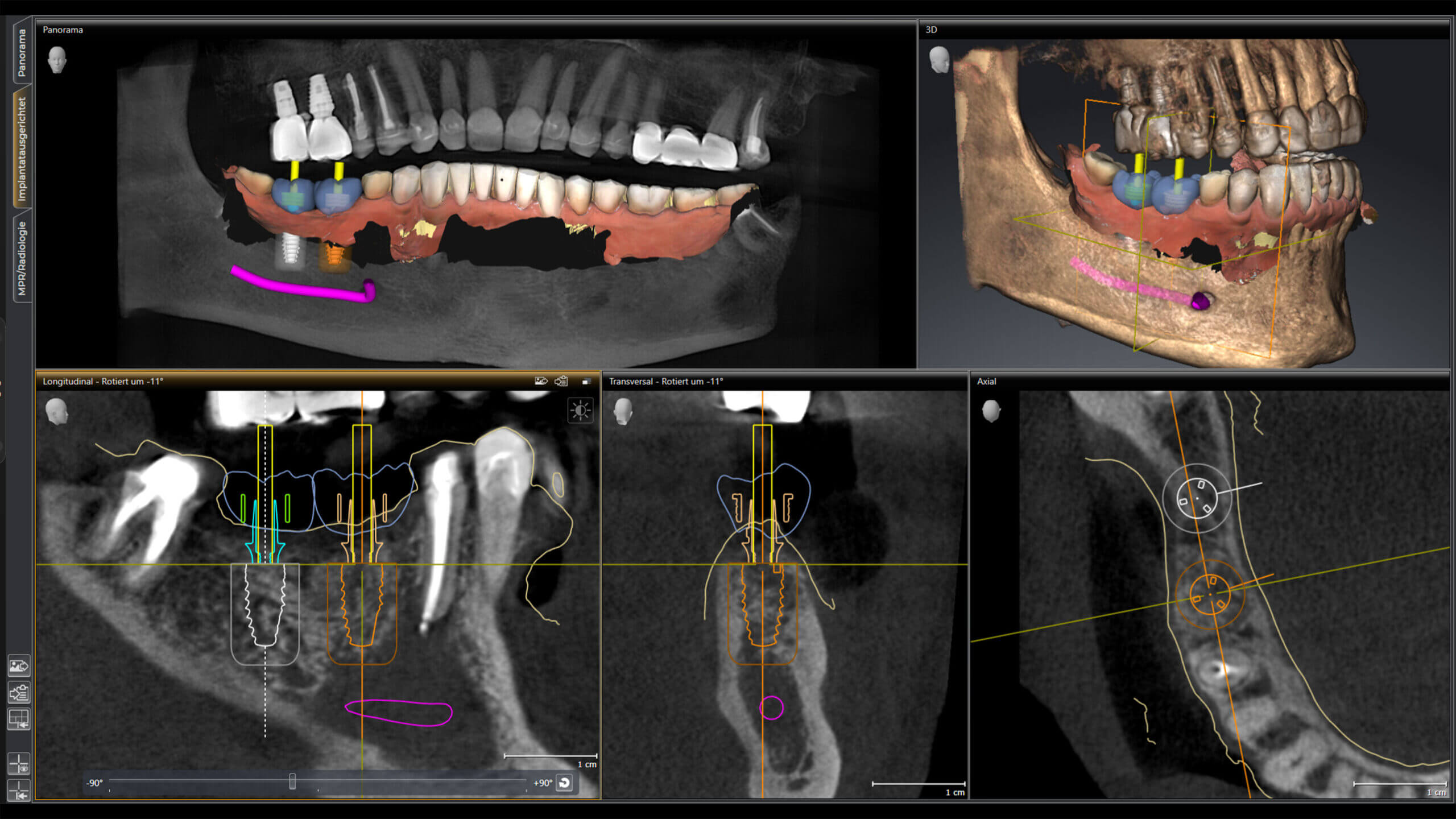 Implantatplanung in Sicat Implant regio 46 und 47