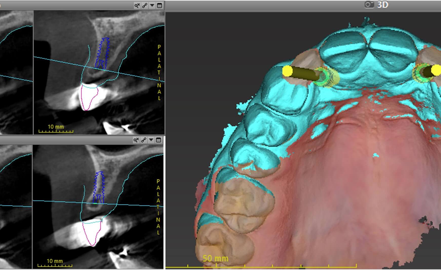 Abb. 5: 3D-Planung in coDiagnostiX