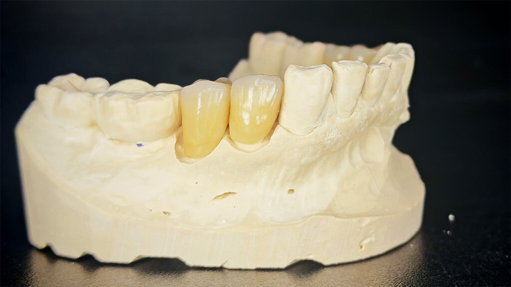 Monolithisch aus dem dima Mill Zirconia Multi Zirkon A3 gefräste, glasierte Krone