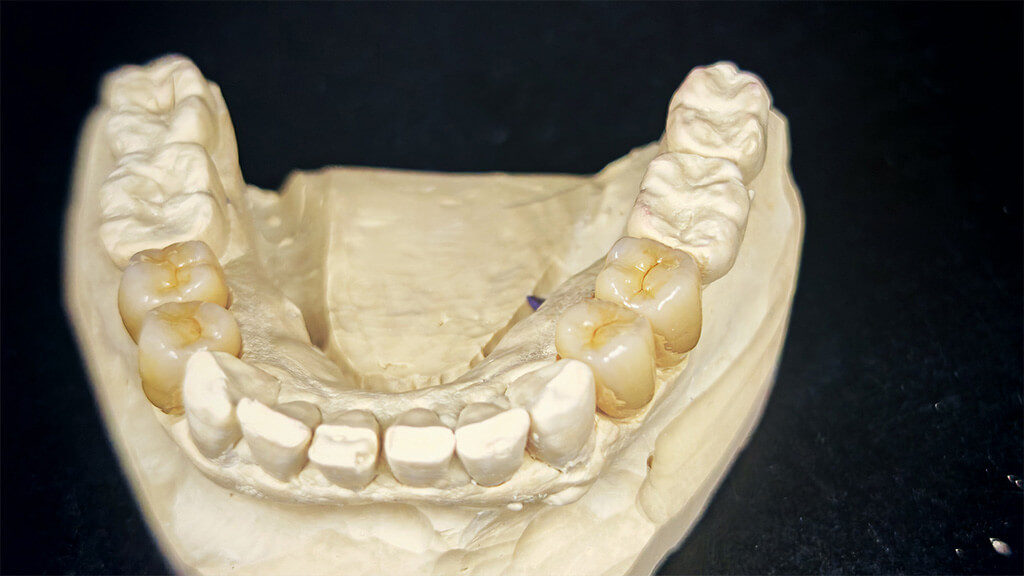 Monolithisch aus dem dima Mill Zirconia Multi Zirkon A3 gefräste, glasierte Krone