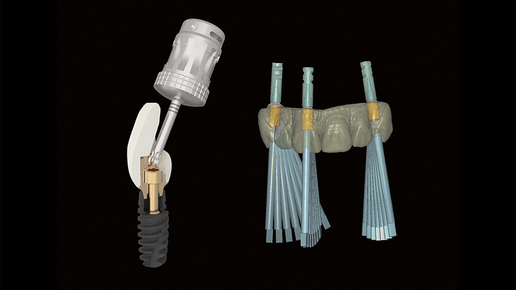 Mit den neuen Titanbasen K80 Angled Screw Channel (ASC) von Zirkonzahn kann der Zugang des Schraubenkanals von 0° bis 30° anguliert werden.