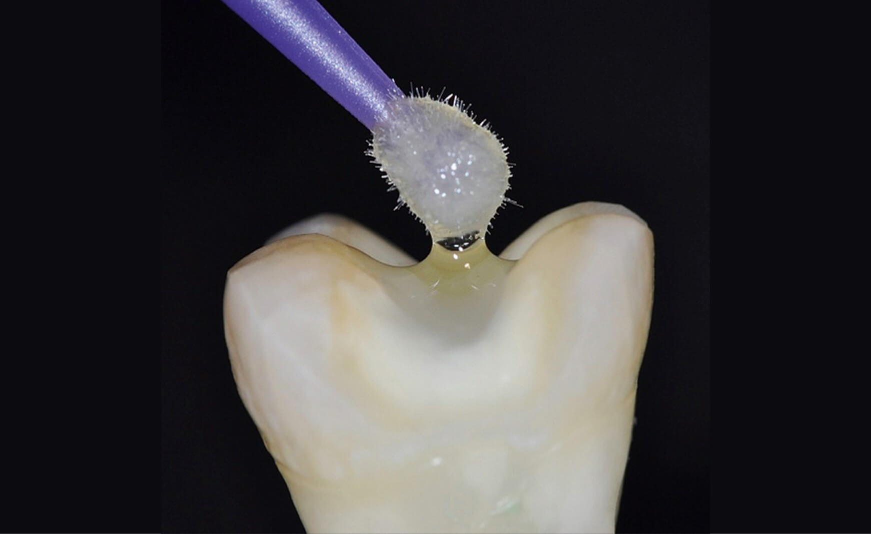 Adhäsivtechnik ermöglicht minimal-invasives Restaurieren.