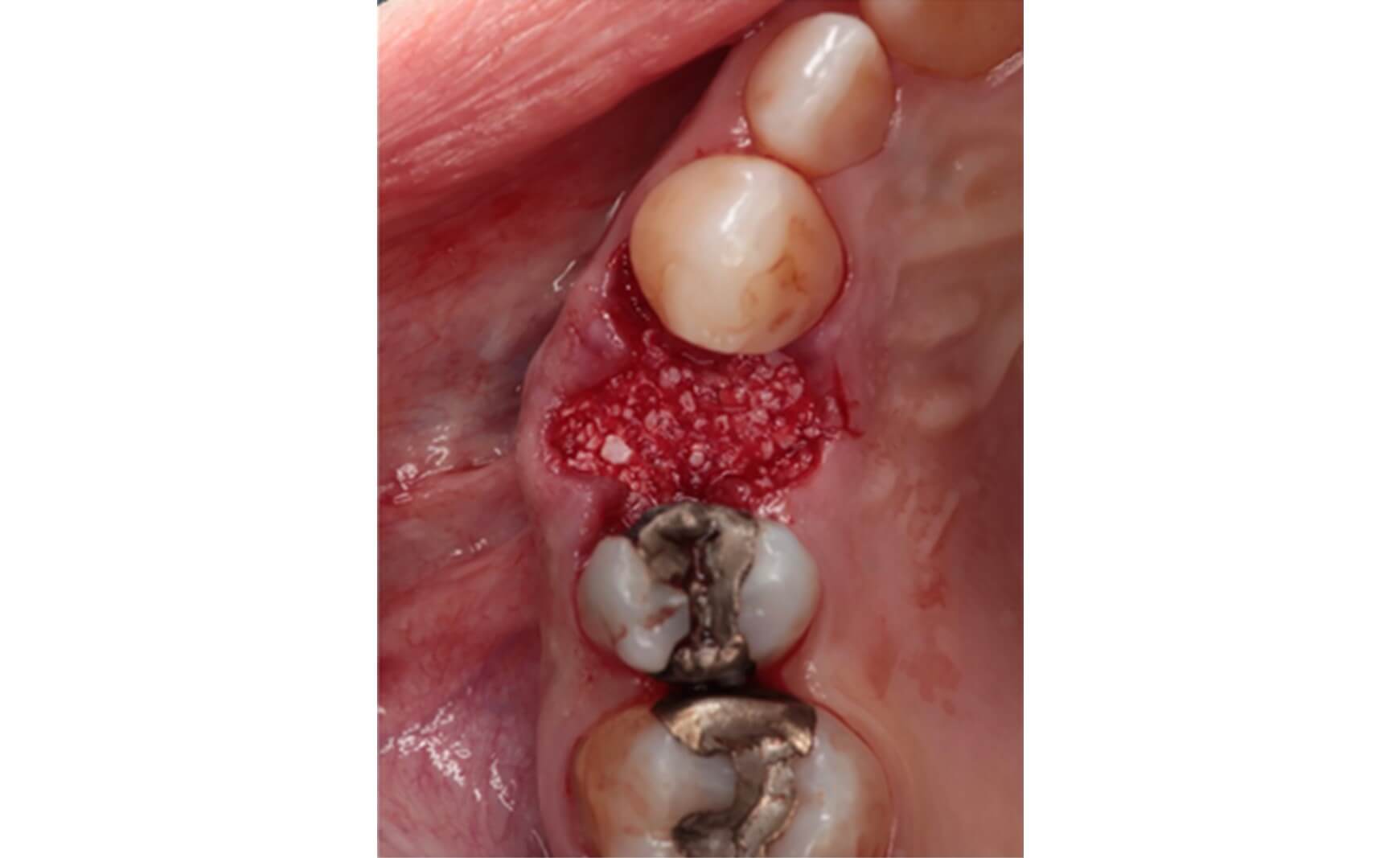 Abb. 3: Alveolar Ridge Preservation: Auffüllen der Extraktionsalveole mit Straumann
XenoFlex.
