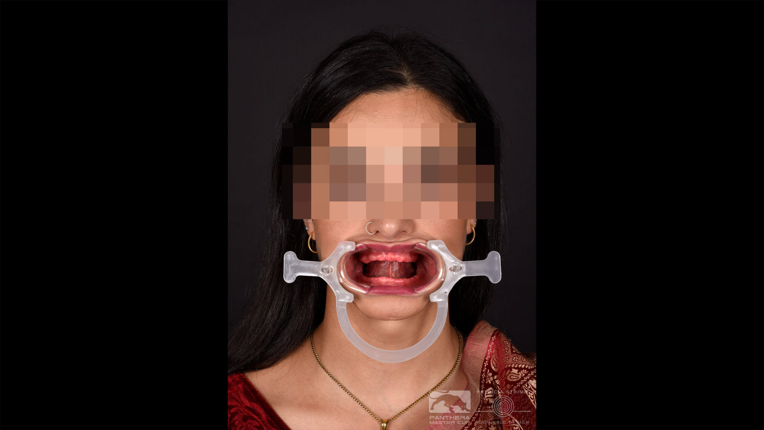 Die klinische Ausgangssituation: Nach Entnahme der Totalprothesen zeigt sich die anatomische Situation. Die Kieferkämme weisen gute Voraussetzungen für eine implantatgetragene Versorgung auf.
