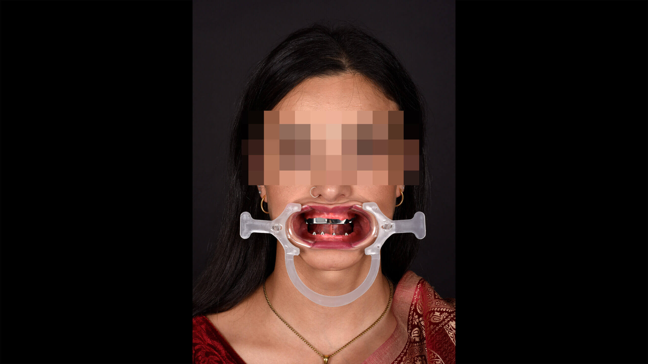 ​​Im Oberkiefer der individuell gefräste Steg auf fünf Implantaten, im Unterkiefer die vier Multiunit-Abutments. Diese Basis-Konstruktion wird zum Fundament für die prothetische Versorgung. Die exakte Positionierung der Aufbauten bestimmt die spätere Ästhetik und Funktion der definitiven Arbeit.