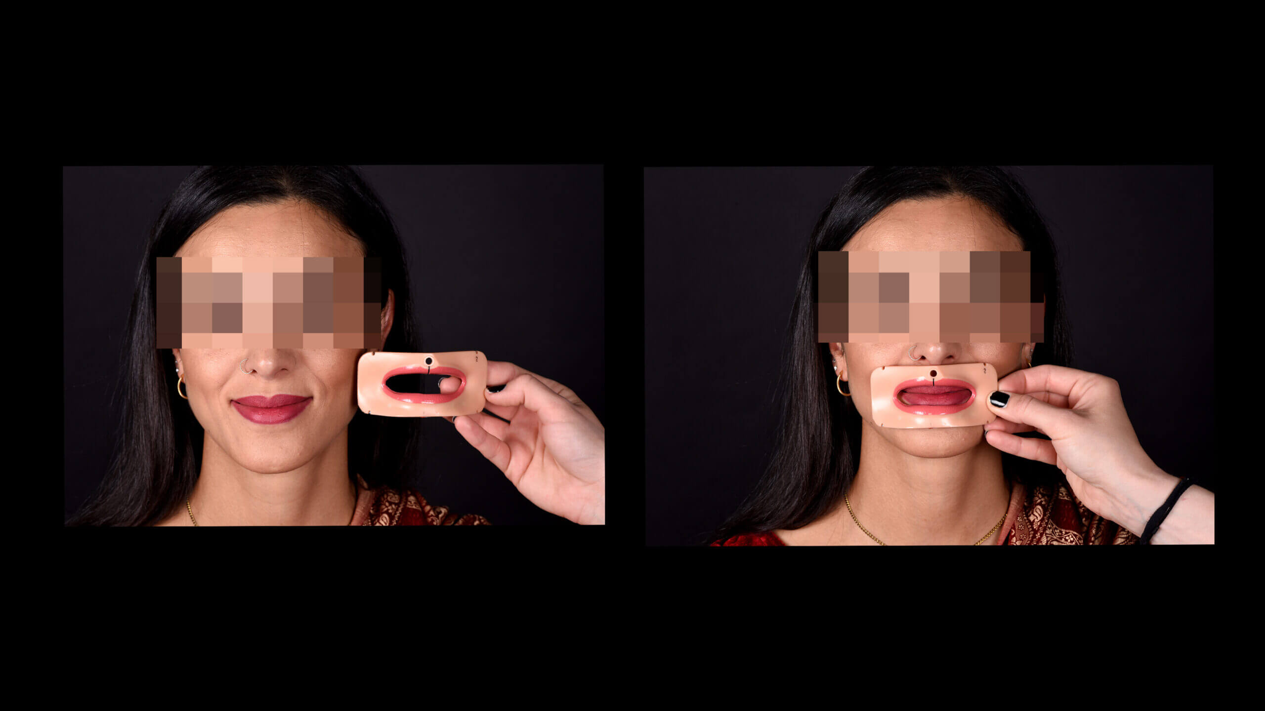 Hinter den Kulissen: Mit dem Lippenschild aus Silikon analysierte ich die dynamische Beziehung zwischen Lippen und Zähnen. Diese dreidimensionale „Blaupause“ der Lippenposition ermöglicht die präzise Beurteilung des späteren Zusammenspiels von roter und weißer Ästhetik. So können wir bereits in der Planungsphase sehen, wie die Zähne im Zusammenspiel mit den Lippen wirken werden.
