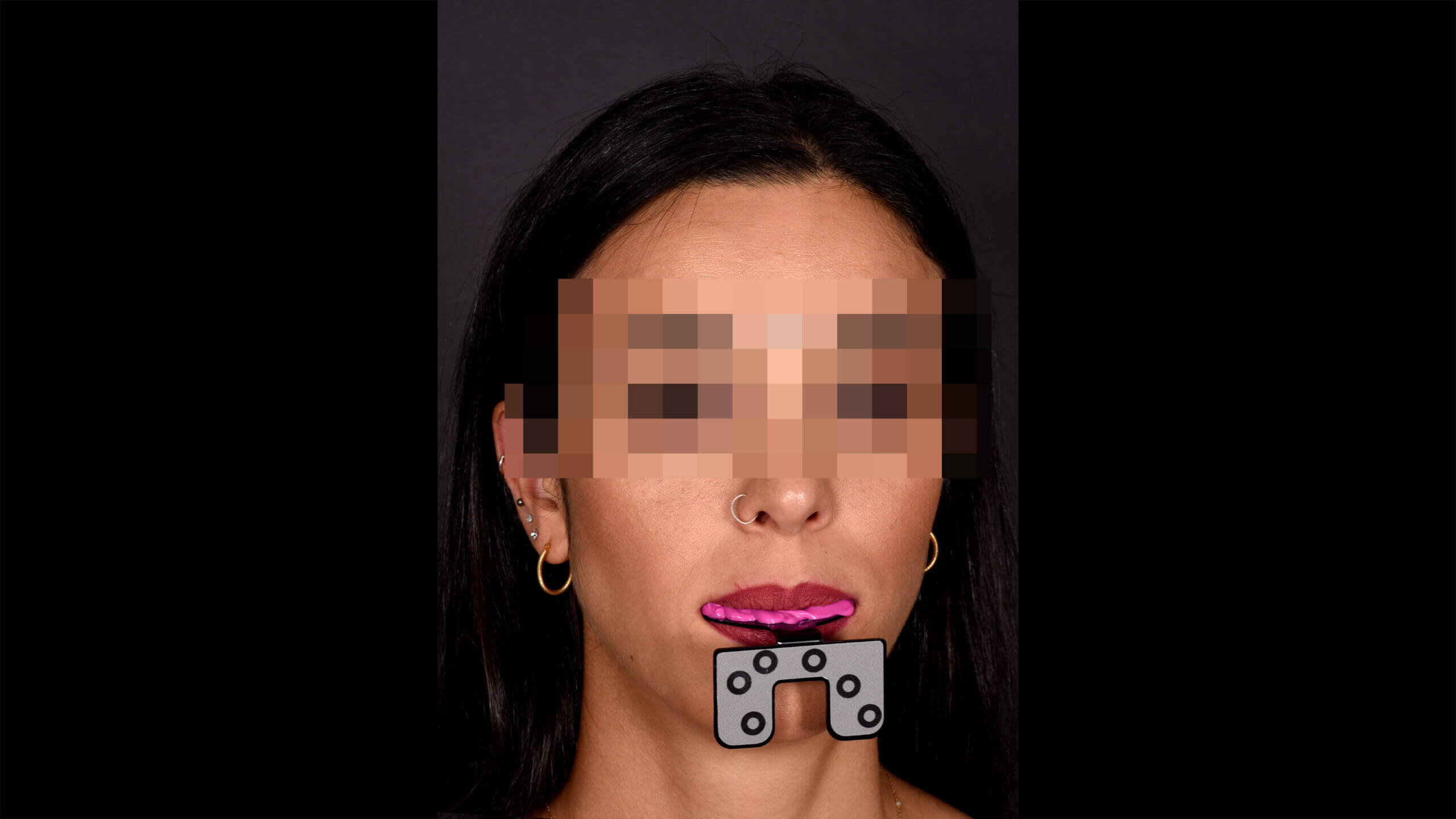 Diese digitalen Daten bilden die Grundlage für die spätere Übertragung in den Smile Creator und damit für die exakte Planung der Zahnstellung im Gesichtskontext.