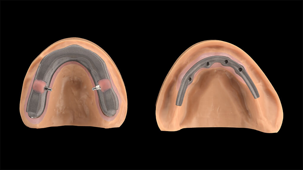 ​​Die technische Basis: Das Panthera-Team lieferte die Gerüstkonstruktionen – im Oberkiefer ein Steggerüst mit Überwurf für eine steggetragene Prothese auf fünf Implantaten, im Unterkiefer das Gerüst für eine bedingt abnehmbare Brücke auf vier Implantaten.