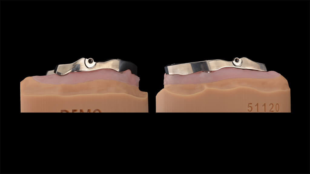 Die seitliche Ansicht des Oberkieferstegs zeigt den harmonischen Verlauf der basalen Fläche. Die präzise Abstimmung mit der Gingiva ist entscheidend für die spätere Hygienefähigkeit.