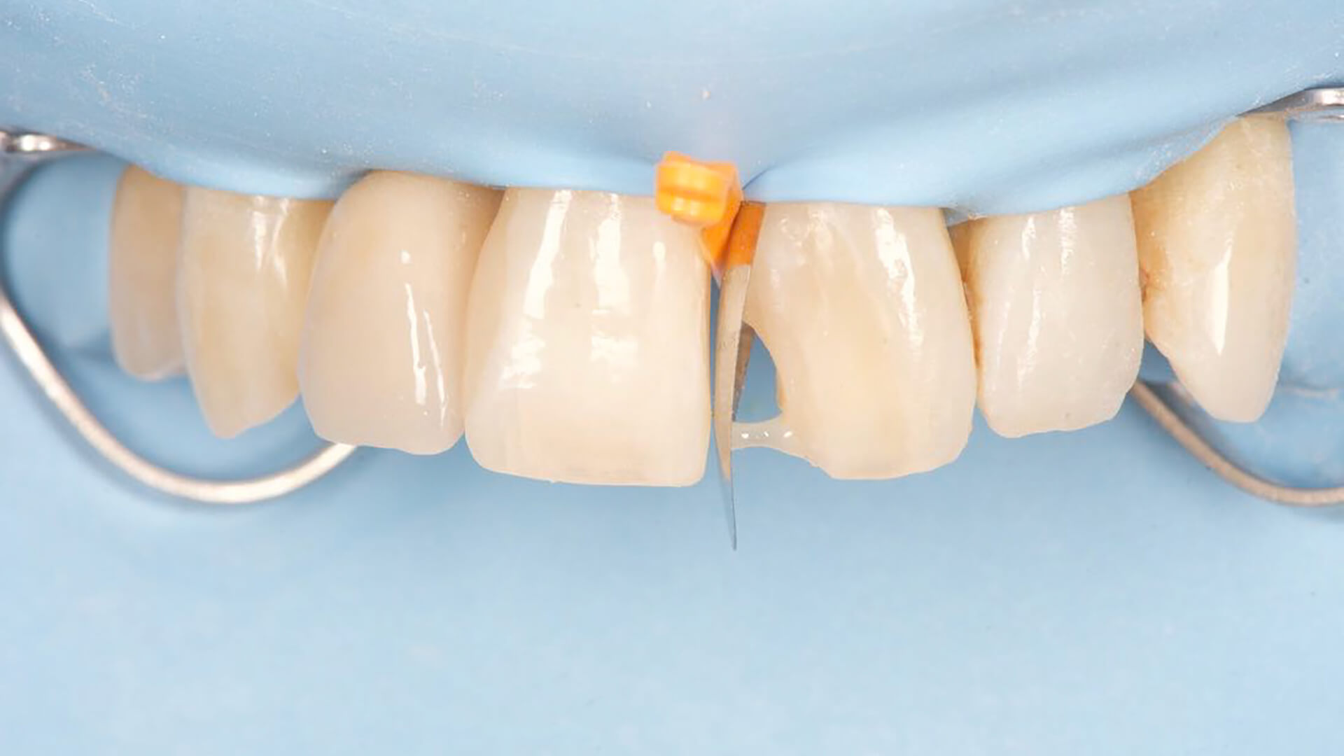 05 Frontalansicht der stabilisierten Matrize